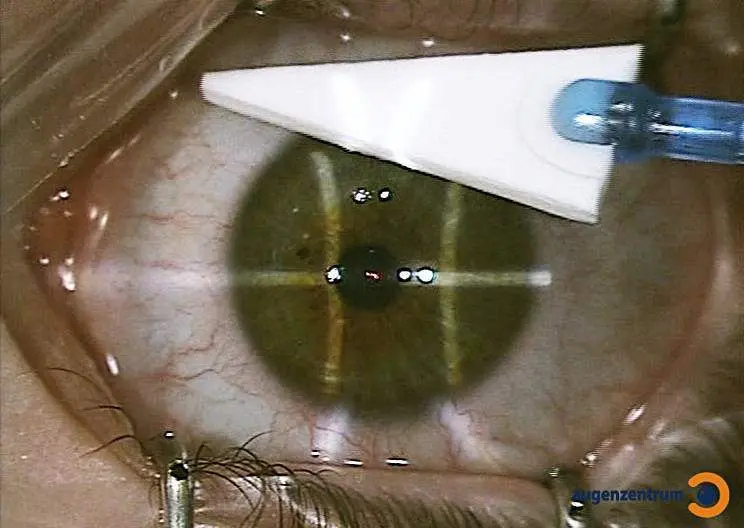 Mit Lidhalter weit geöffnetes Auge: Die Hornhaut wird für die Augenlaserbehandlung mit einem sterilen Stieltupfer sorgfältig vorbereitet.