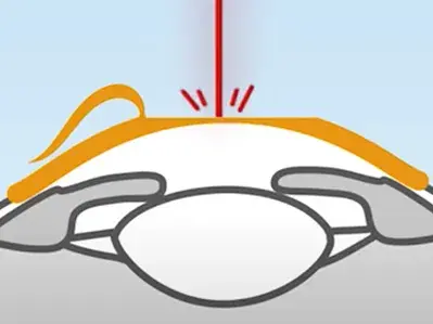 Beim Augenlaser Verfahren LASIK wird ein kleiner Hornhautschnitt gesetzt, der sogenannte "Flap". Dieser muss angehoben werden, damit der Laser in das Gewebe eindringen kann.