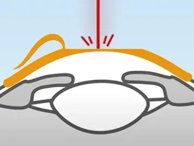 Beim Augenlaser Verfahren LASIK wird ein kleiner Hornhautschnitt gesetzt, der sogenannte "Flap". Dieser muss angehoben werden, damit der Laser in das Gewebe eindringen kann.