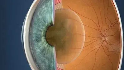 Illustration eines Augenquerschnitts mit trüber, verhärteter Augenlinse beim Grauen Star