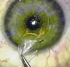 Auge bei einer Augenoperation mit Relex Smile in Nahaufnahme. Gezeigt wird, wie mit einer Pinzette das Lentikel aus der Hornhaut entfernt wird.
