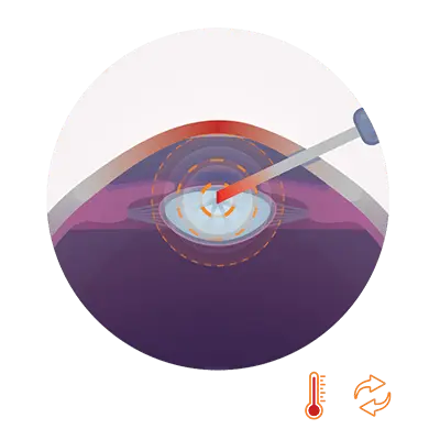 Schematische Darstellung des klassischen Ultraschall-Verfahrens bei der Grauen-Star-Operation: Eine Sonde zertrümmert mit Schallwellen die eingetrübte Augenlinse.