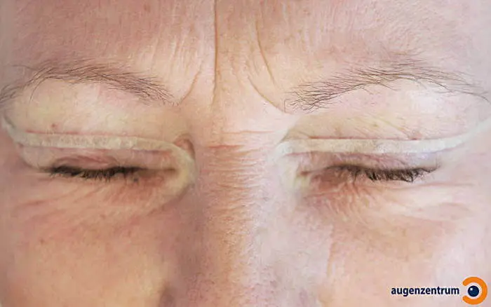 Nahtlinie wird mit sterilen Pflasterstreifchen (Steristrips) abgedeckt