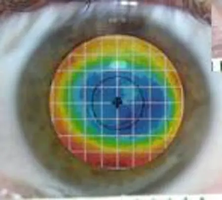 8mm LASIK Halos - Spezialaufnahme, die eine zu kleine optische Zone offenbar.