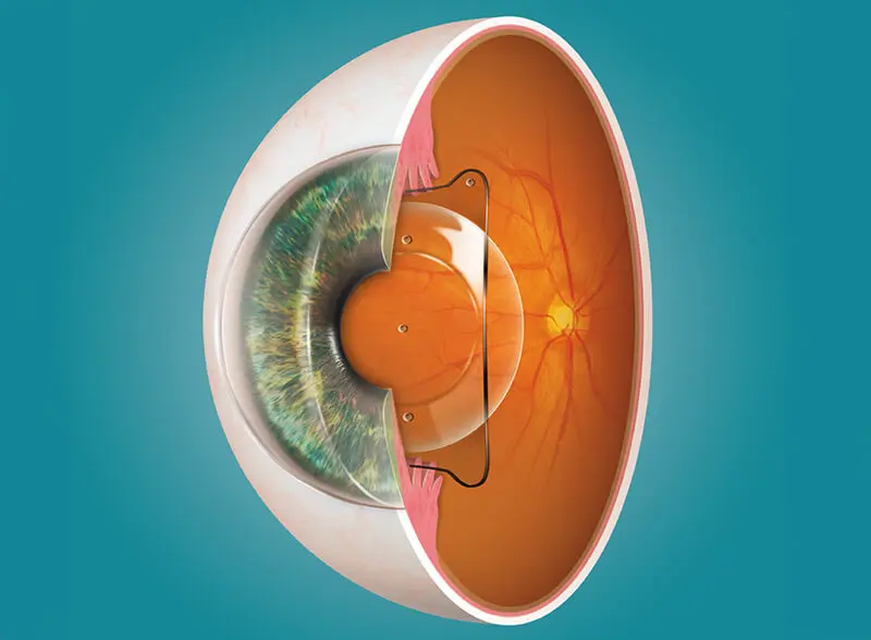 Grafische Darstellung einer implantierbaren phaken EVO Visian ICL-Linse im Auge
