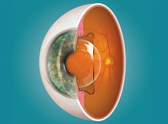 Grafische Darstellung einer implantierbaren phaken EVO Visian ICL-Linse im Auge