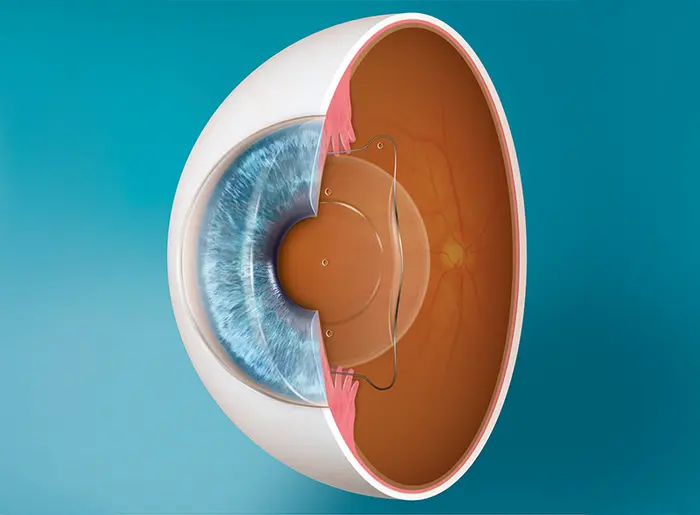 ICL Implantat - schematische Darstellung einer implantierbaren Linse hinter der Pupille, minimalinvasives Verfahren ohne Hornhautabtragung.