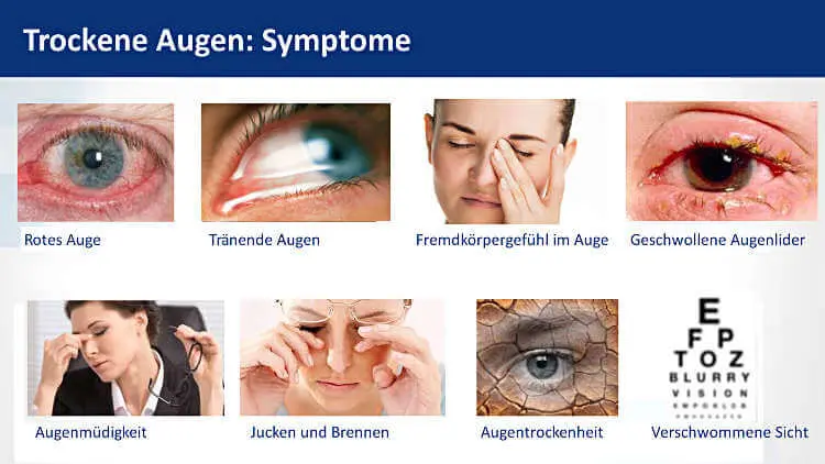 Trockene Augen Symptome: Rotes Auge, Tränende Augen, Fremdkörpergefühl, Geschwollene Augenlider, Augenmüdigkeit, Jucken und Brennen, Tockenes Gefühl, Verschwommene Sicht