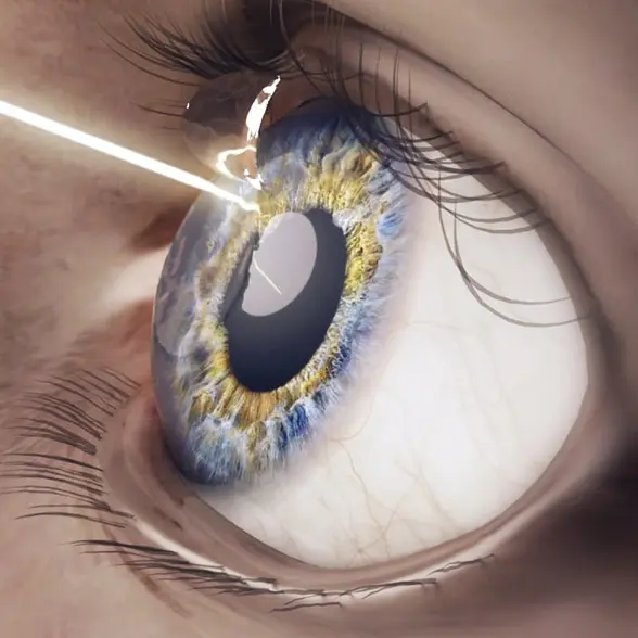 Symbolisches Bild: Laserstrahl trifft auf ein geöffnetes Auge.