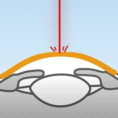 Beim SMART Pro Augenlasern wird kein "Flap" benötigt und somit muss kein Hornhautschnitt gemacht werden.