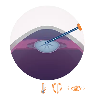 Grafische Querschnitts-Darstellung eines Auges, in dessen Linse eine feine Nanolaser-Sonde präzise Energie abgibt.